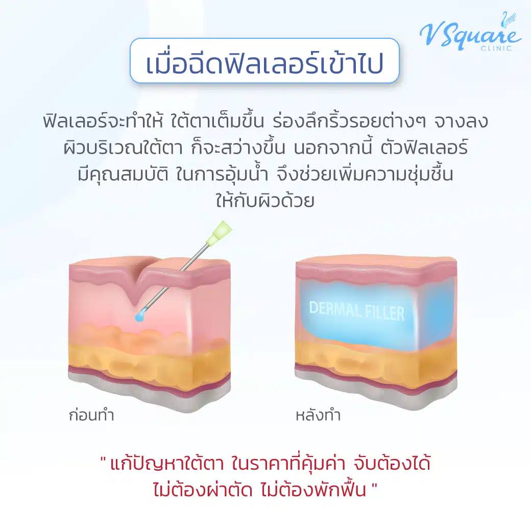ฉีดฟิลเลอร์ใต้ตา คืออะไร