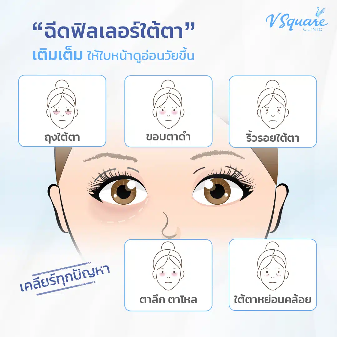 ฉีดฟิลเลอร์ใต้ตา เหมาะกับใคร