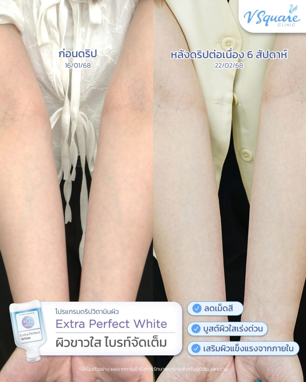 ฉีดวิตามินผิวรีวิว