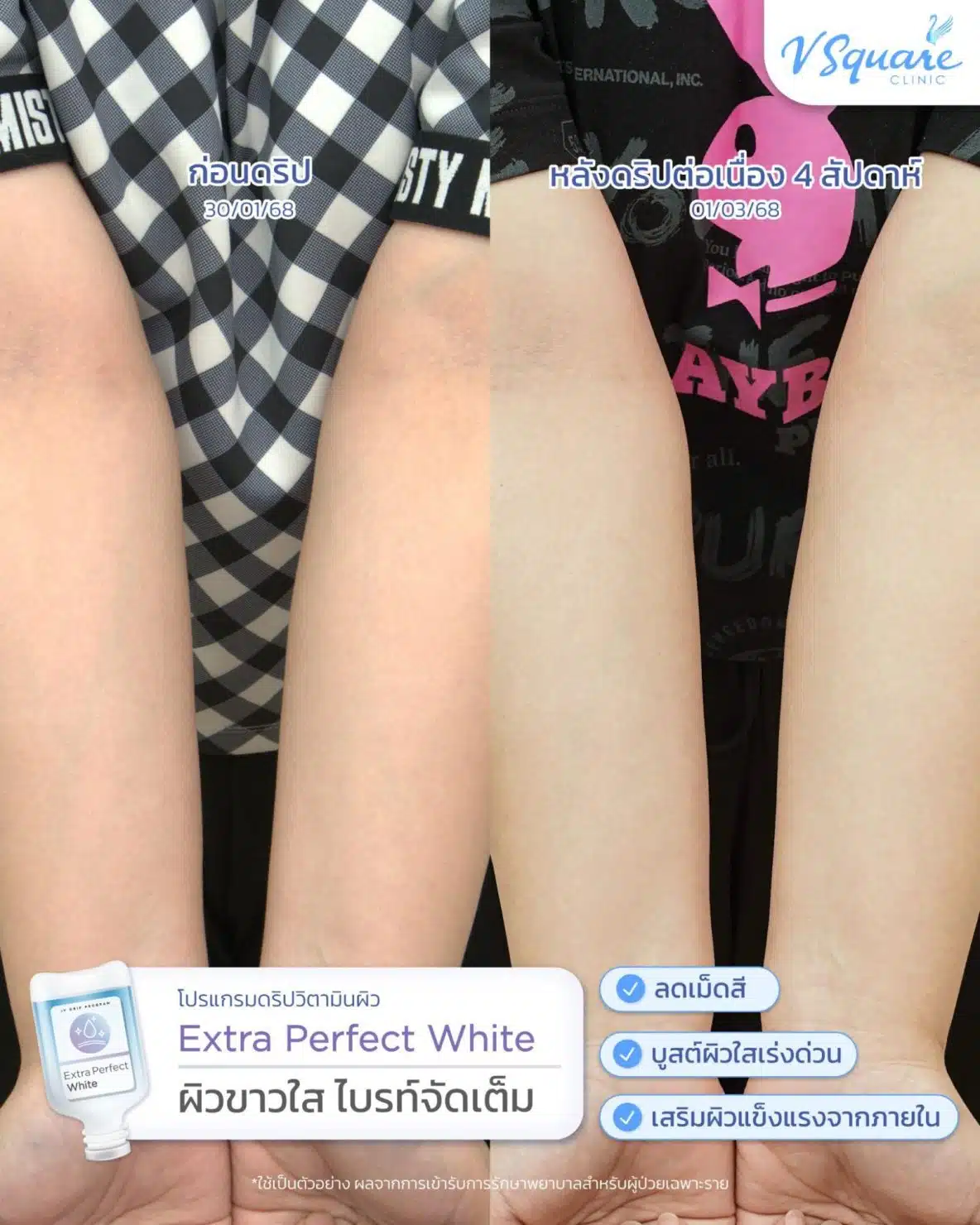 ฉีดวิตามินผิวรีวิว