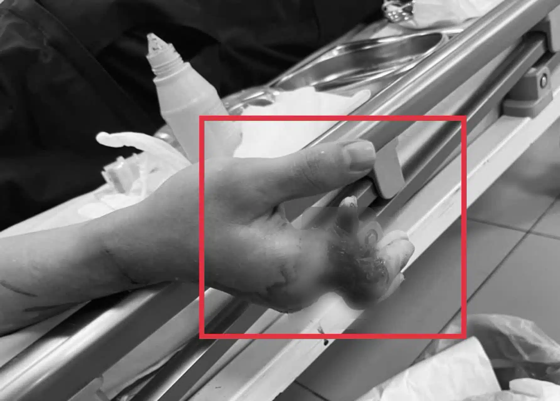 นิ้วมือที่ได้รับการเชื่อมต่อเส้นเลือดและเส้นประสาทแล้ว