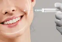 ฟิลเลอร์ร่องแก้ม