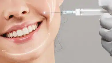 ฟิลเลอร์ร่องแก้ม