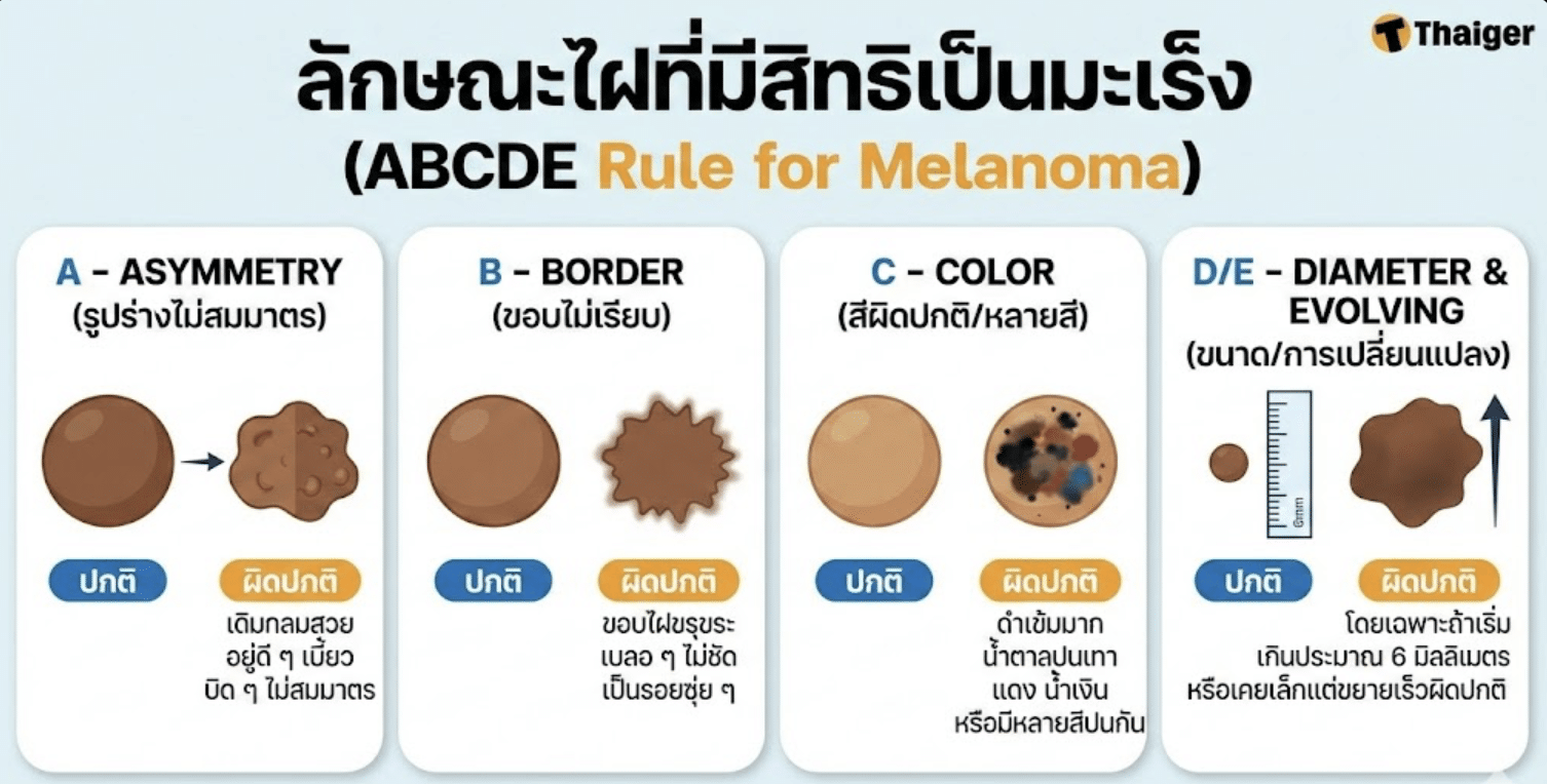 ลักษณะไฝที่เสี่ยงเป็นมะเร็งผิวหนัง