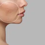 รักษาหลุมสิว ที่ไหนดี