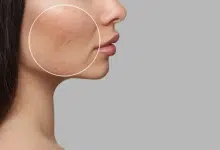 รักษาหลุมสิว ที่ไหนดี