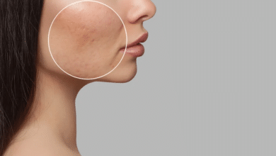 รักษาหลุมสิว ที่ไหนดี