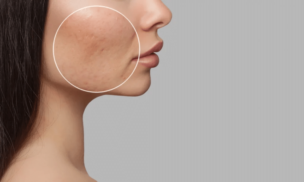 รักษาหลุมสิว ที่ไหนดี