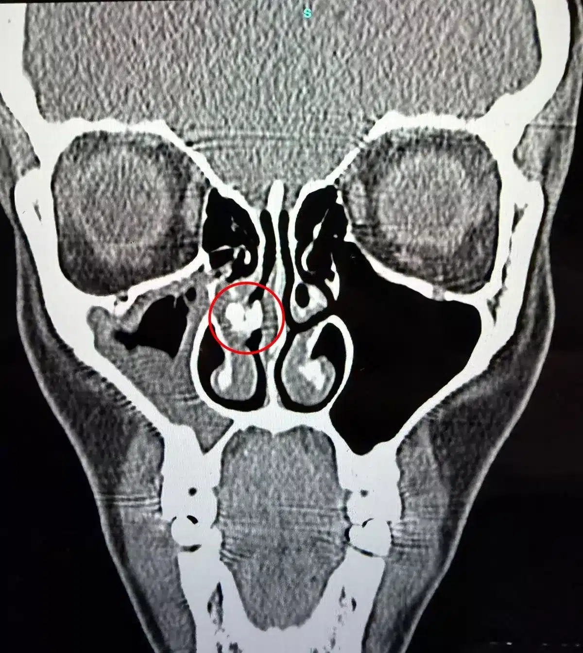 ภาพฟิล์มเอกซเรย์แสดงก้อนเงาทึบแสงบริเวณโพรงจมูกด้านขวา