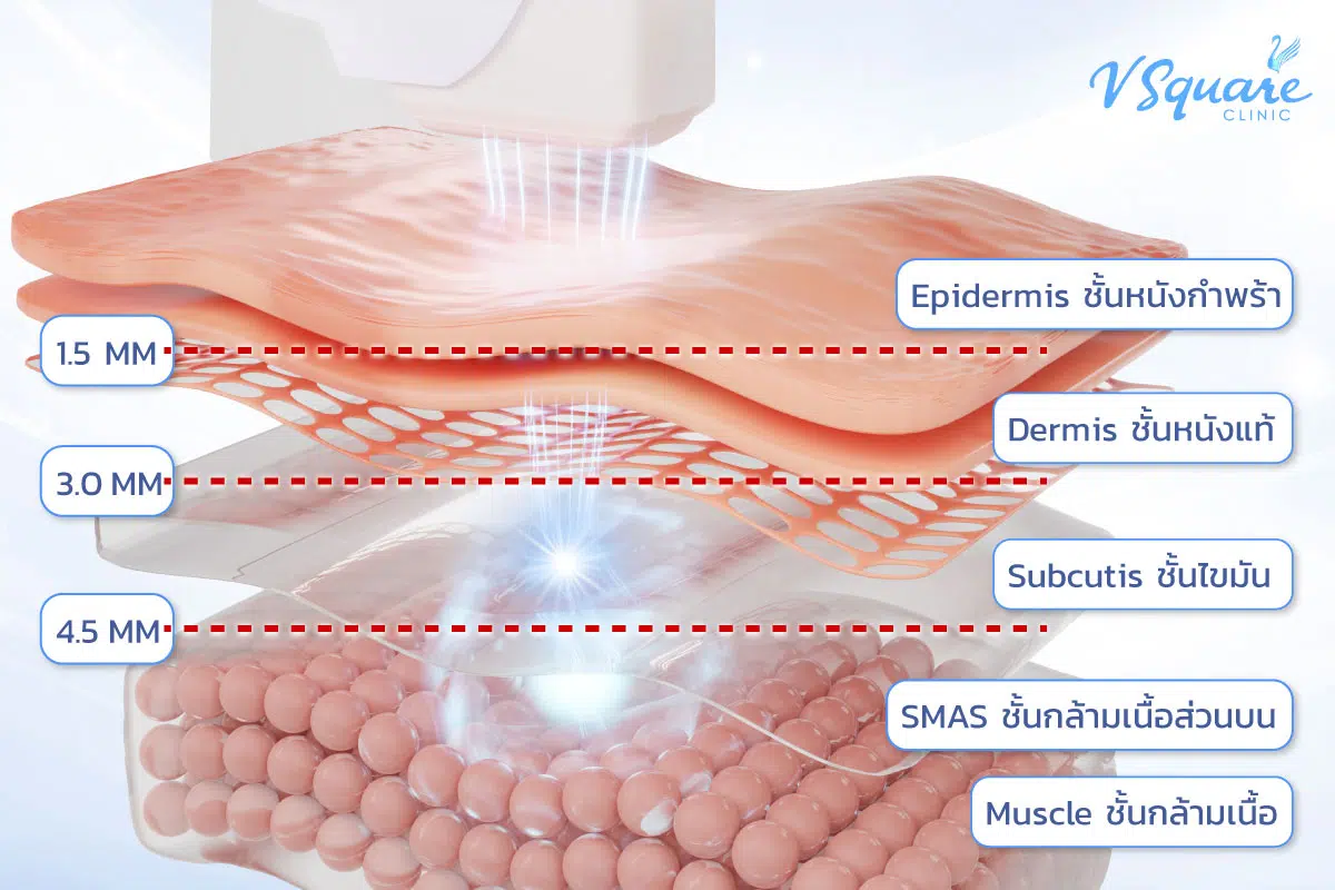 หลักการทำงาน Hifu