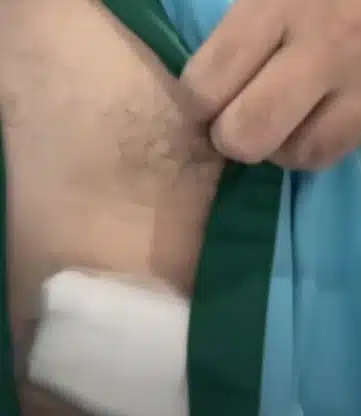 อาการล่าสุด ต้น จักรกฤษณ์ หลังผ่าเปิดหน้าท้อง ตัดถุงน้ำดีทิ้ง ซูบผอมจำแทบไม่ได้ -4