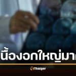 อดีตนางงาม ก้มผูกเชือกรองเท้าไม่ได้ นึกว่าติดหน้าอก ที่แท้ "เนื้องอก" ใหญ่เท่าส้มโอ