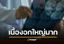 อดีตนางงาม ก้มผูกเชือกรองเท้าไม่ได้ นึกว่าติดหน้าอก ที่แท้ "เนื้องอก" ใหญ่เท่าส้มโอ