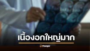 อดีตนางงาม ก้มผูกเชือกรองเท้าไม่ได้ นึกว่าติดหน้าอก ที่แท้ "เนื้องอก" ใหญ่เท่าส้มโอ