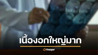 อดีตนางงาม ก้มผูกเชือกรองเท้าไม่ได้ นึกว่าติดหน้าอก ที่แท้ "เนื้องอก" ใหญ่เท่าส้มโอ