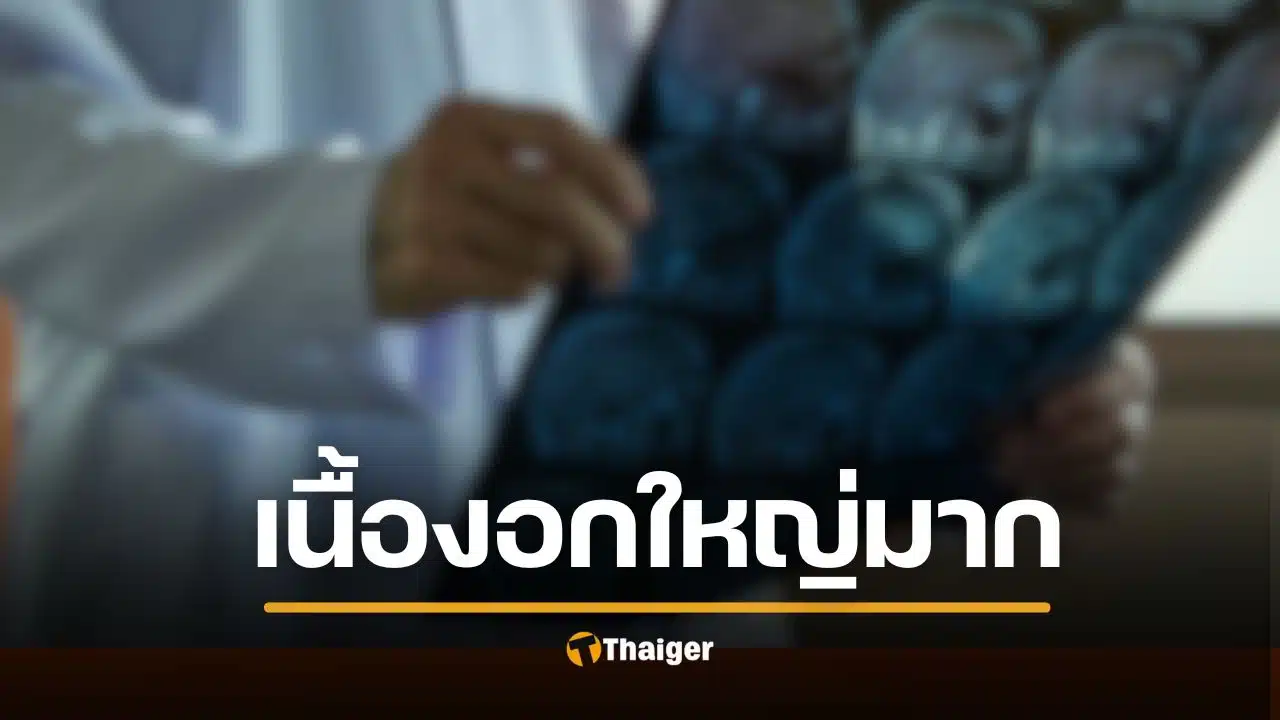 อดีตนางงาม ก้มผูกเชือกรองเท้าไม่ได้ นึกว่าติดหน้าอก ที่แท้ "เนื้องอก" ใหญ่เท่าส้มโอ