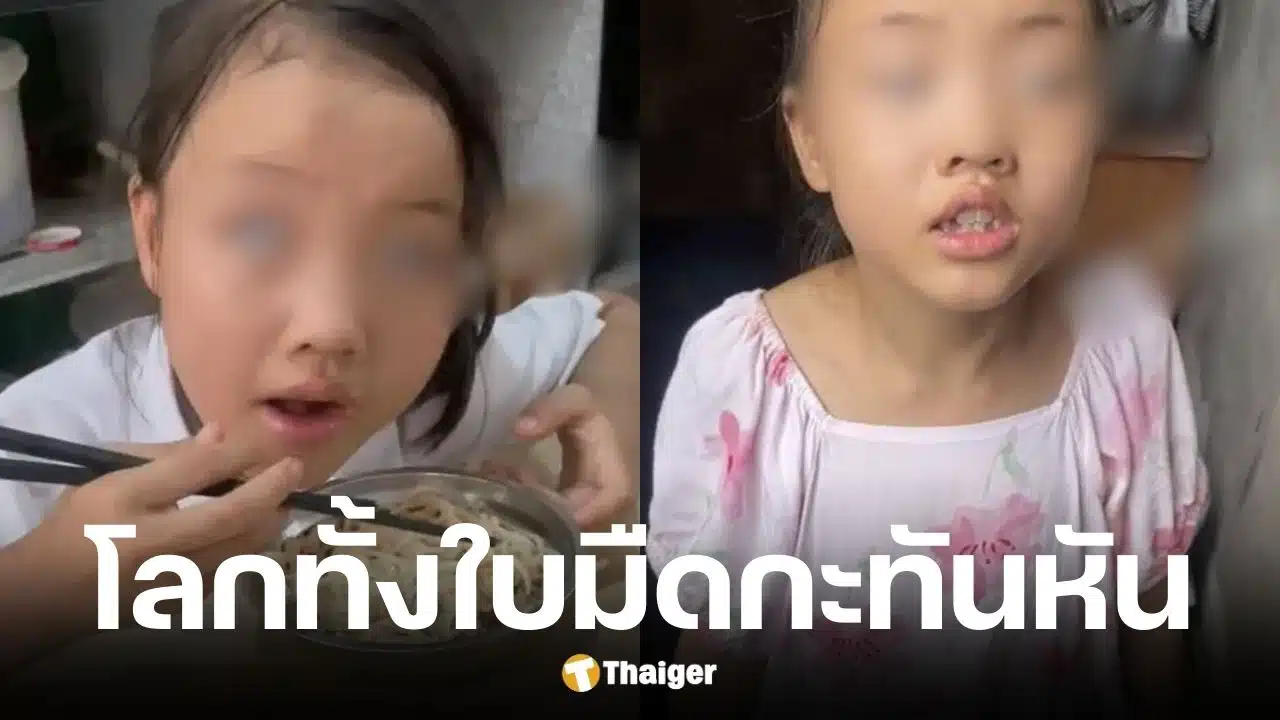 หนูน้อย 2 ขวบตาบอดกะทันหันเพราะยีนกลายพันธุ์หายาก