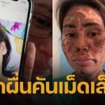 สาวแชร์อุทาหรณ์ “ผื่นเม็ดเล็ก” ลามหนักเป็นตุ่มน้ำพอง-ผิวไหม้ ขนร่วงเกือบทั้งตัว ยังไม่รู้สาเหตุแน่ชัด