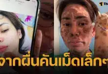 สาวแชร์อุทาหรณ์ “ผื่นเม็ดเล็ก” ลามหนักเป็นตุ่มน้ำพอง-ผิวไหม้ ขนร่วงเกือบทั้งตัว ยังไม่รู้สาเหตุแน่ชัด