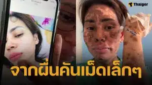 สาวแชร์อุทาหรณ์ “ผื่นเม็ดเล็ก” ลามหนักเป็นตุ่มน้ำพอง-ผิวไหม้ ขนร่วงเกือบทั้งตัว ยังไม่รู้สาเหตุแน่ชัด
