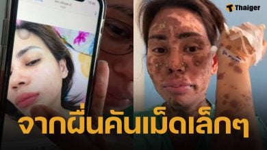 สาวแชร์อุทาหรณ์ “ผื่นเม็ดเล็ก” ลามหนักเป็นตุ่มน้ำพอง-ผิวไหม้ ขนร่วงเกือบทั้งตัว ยังไม่รู้สาเหตุแน่ชัด