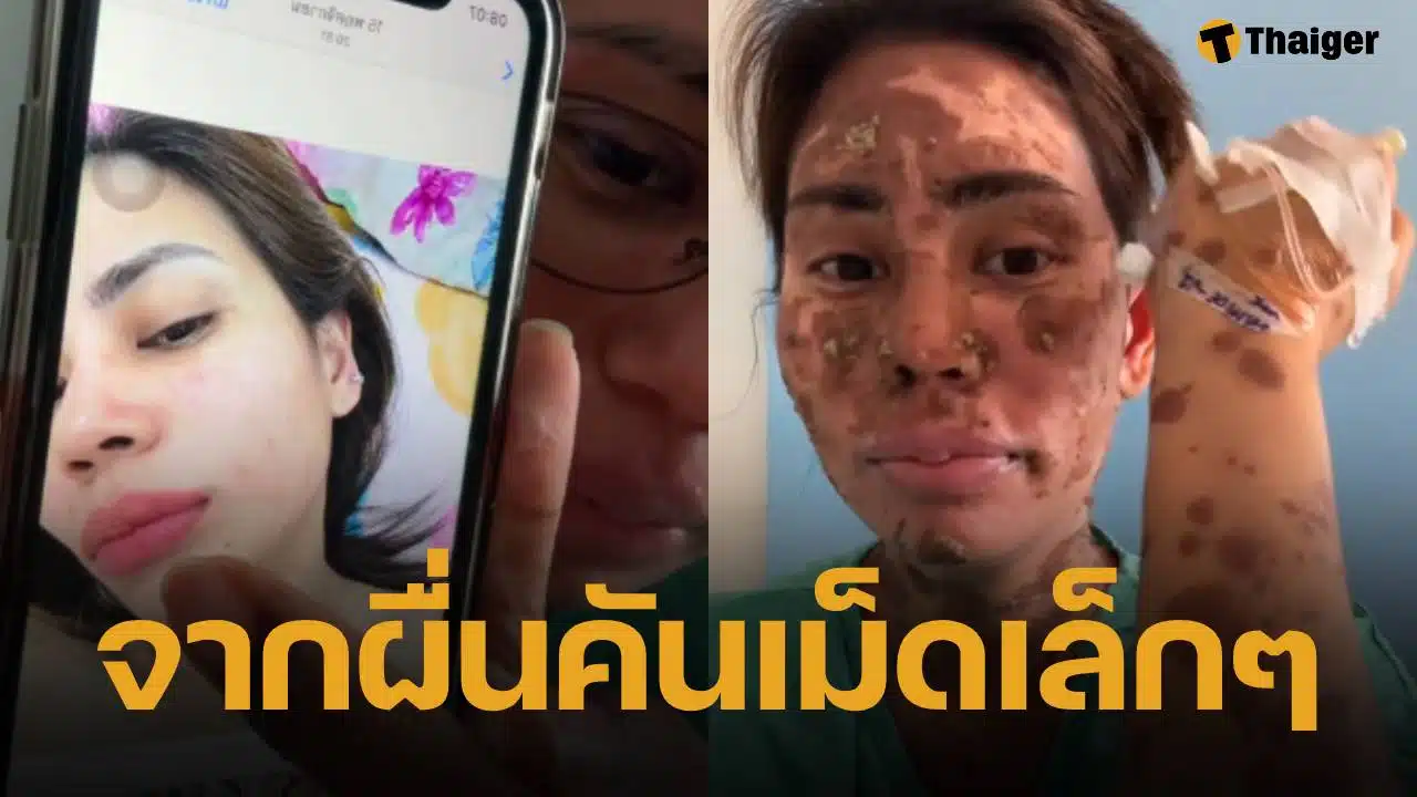 สาวแชร์อุทาหรณ์ “ผื่นเม็ดเล็ก” ลามหนักเป็นตุ่มน้ำพอง-ผิวไหม้ ขนร่วงเกือบทั้งตัว ยังไม่รู้สาเหตุแน่ชัด