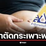 ข่าวดีมนุษย์เงินเดือน ประกันสังคม ยืนยัน ผู้ประกันตน ม.33-39 ป่วย "โรคอ้วน" ผ่าตัดกระเพาะฟรี เช็กเงื่อนไขด่วน