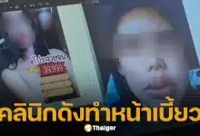 สวยสยอง! สาวเตือนภัย ฉีดฟิลเลอร์คลินิกดัง ทำหน้าเบี้ยว-บวมผิดรูป จี้แพทยสภาสอบด่วน