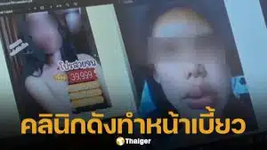 สวยสยอง! สาวเตือนภัย ฉีดฟิลเลอร์คลินิกดัง ทำหน้าเบี้ยว-บวมผิดรูป จี้แพทยสภาสอบด่วน