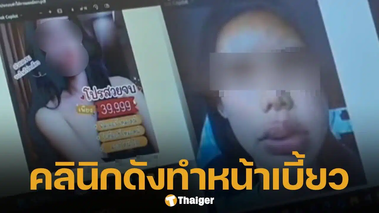 สวยสยอง! สาวเตือนภัย ฉีดฟิลเลอร์คลินิกดัง ทำหน้าเบี้ยว-บวมผิดรูป จี้แพทยสภาสอบด่วน