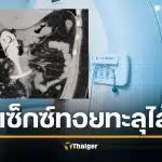 เคสสยอง สาวหวิดดับคาเครื่อง MRI ใส่ "ปลั๊กเสียบก้น" ดูดทะลุอวัยวะถึงอก