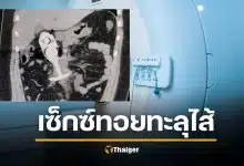 เคสสยอง สาวหวิดดับคาเครื่อง MRI ใส่ "ปลั๊กเสียบก้น" ดูดทะลุอวัยวะถึงอก