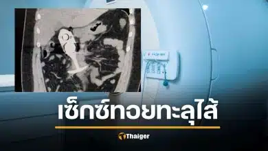 เคสสยอง สาวหวิดดับคาเครื่อง MRI ใส่ "ปลั๊กเสียบก้น" ดูดทะลุอวัยวะถึงอก