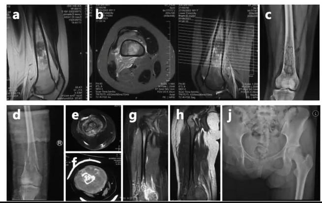 เสี่ยว ซื่อเว่ย รักษามะเร็ง