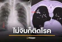 น่ากลัวมาก ชายแข็งแรงดี แค่นกพิราบเกาะหลังคา สูดสปอร์ราเข้าปอดจนป่วย