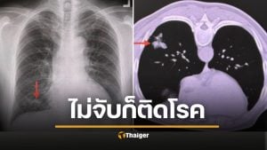 น่ากลัวมาก ชายแข็งแรงดี แค่นกพิราบเกาะหลังคา สูดสปอร์ราเข้าปอดจนป่วย