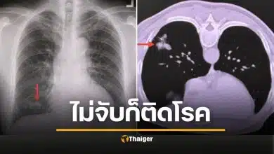 น่ากลัวมาก ชายแข็งแรงดี แค่นกพิราบเกาะหลังคา สูดสปอร์ราเข้าปอดจนป่วย