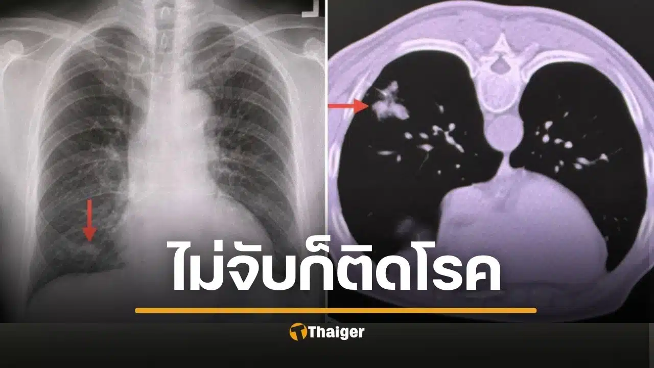 น่ากลัวมาก ชายแข็งแรงดี แค่นกพิราบเกาะหลังคา สูดสปอร์ราเข้าปอดจนป่วย