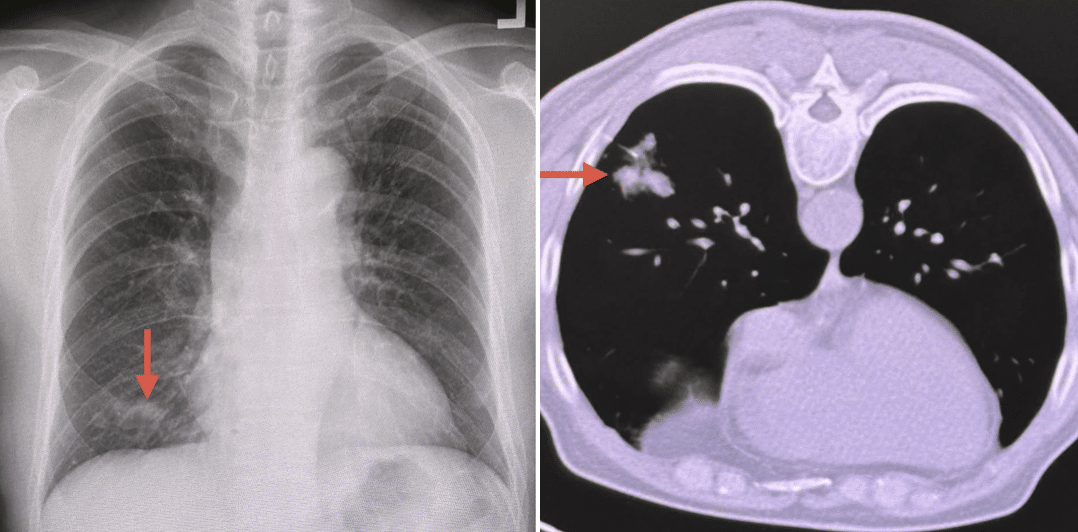 น่ากลัวมาก ชายแข็งแรงดี แค่นกพิราบเกาะหลังคา สูดสปอร์ราเข้าปอดจนป่วย