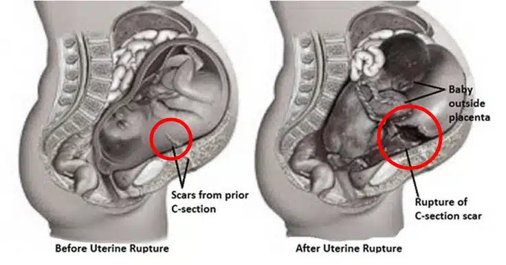 รู้จักภาวะ มดลูกแตก คืออะไร มหัตภัยร้ายที่อาจพรากชีวิตทั้งแม่และลูกในท้อง-1