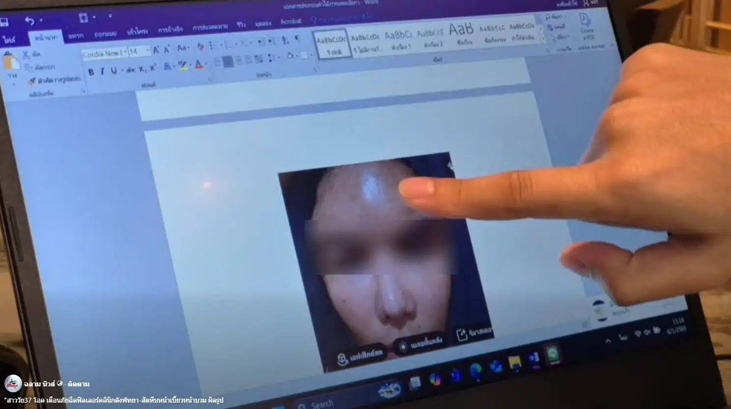 สาวเตือนภัย หลงเชื่อโปรฉีดฟิลเลอร์ ราคาถูก ทำหน้าเบี้ยวผิดรูป-4