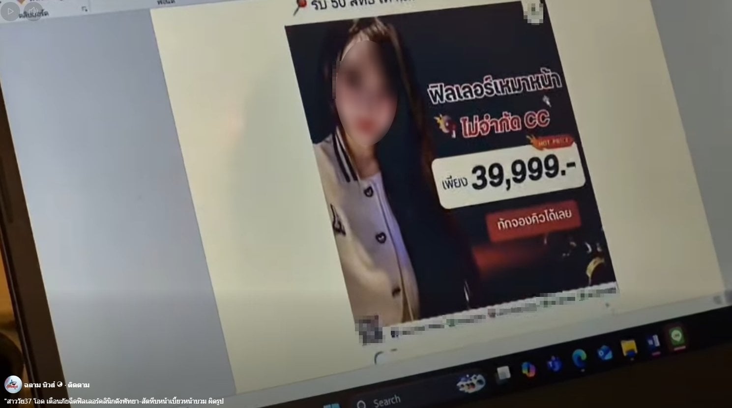 สาวเตือนภัย หลงเชื่อโปรฉีดฟิลเลอร์ ราคาถูก ทำหน้าเบี้ยวผิดรูป-5