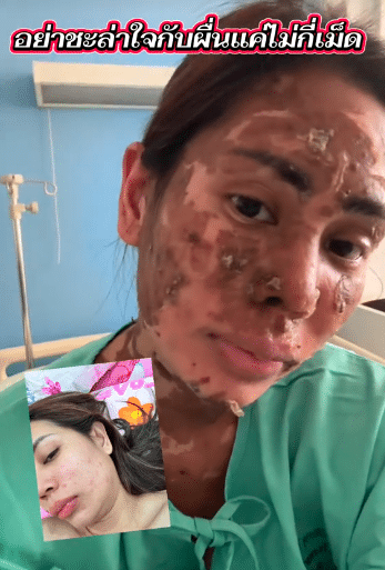 สาวแชร์อุทาหรณ์ “ผื่นเม็ดเล็ก” ลามหนักเป็นตุ่มน้ำพอง-ผิวไหม้ ขนร่วงเกือบทั้งตัว-1