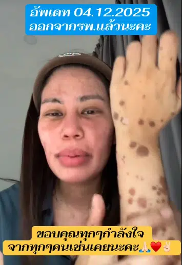 สาวแชร์อุทาหรณ์ “ผื่นเม็ดเล็ก” ลามหนักเป็นตุ่มน้ำพอง-ผิวไหม้ ขนร่วงเกือบทั้งตัว-2