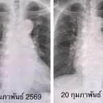 หมอมนูญยกเคส "โบคาไวรัส" ทำปอดอักเสบ-หัวใจเต้นผิดจังหวะ ยังไม่มีวัคซีนป้องกัน