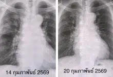 หมอมนูญยกเคส "โบคาไวรัส" ทำปอดอักเสบ-หัวใจเต้นผิดจังหวะ ยังไม่มีวัคซีนป้องกัน