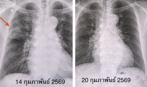 หมอมนูญยกเคส "โบคาไวรัส" ทำปอดอักเสบ-หัวใจเต้นผิดจังหวะ ยังไม่มีวัคซีนป้องกัน