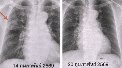 หมอมนูญยกเคส "โบคาไวรัส" ทำปอดอักเสบ-หัวใจเต้นผิดจังหวะ ยังไม่มีวัคซีนป้องกัน