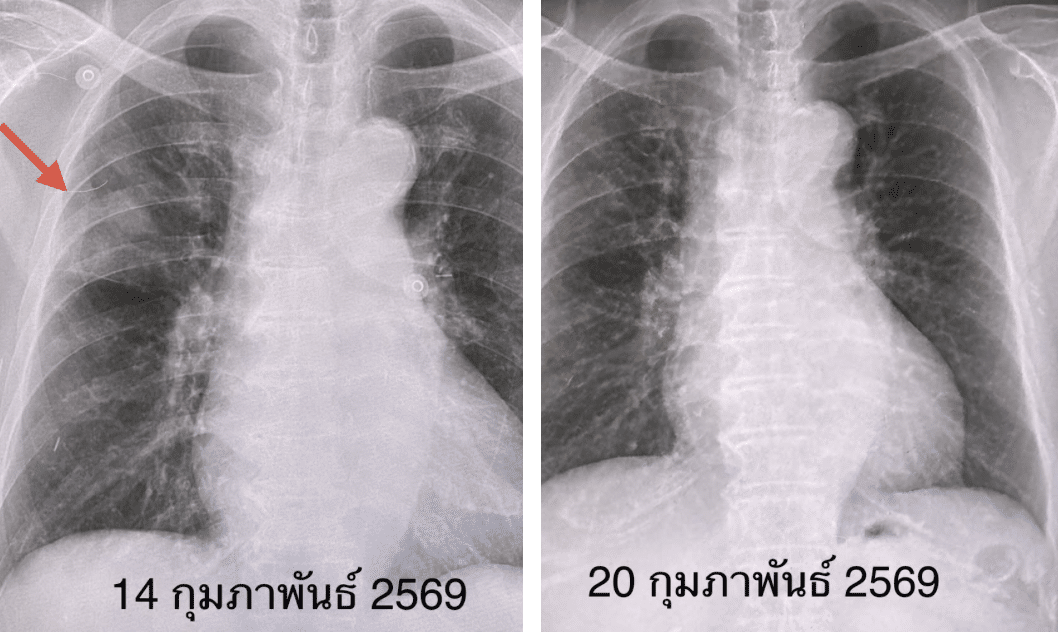 หมอมนูญยกเคส "โบคาไวรัส" ทำปอดอักเสบ-หัวใจเต้นผิดจังหวะ ยังไม่มีวัคซีนป้องกัน