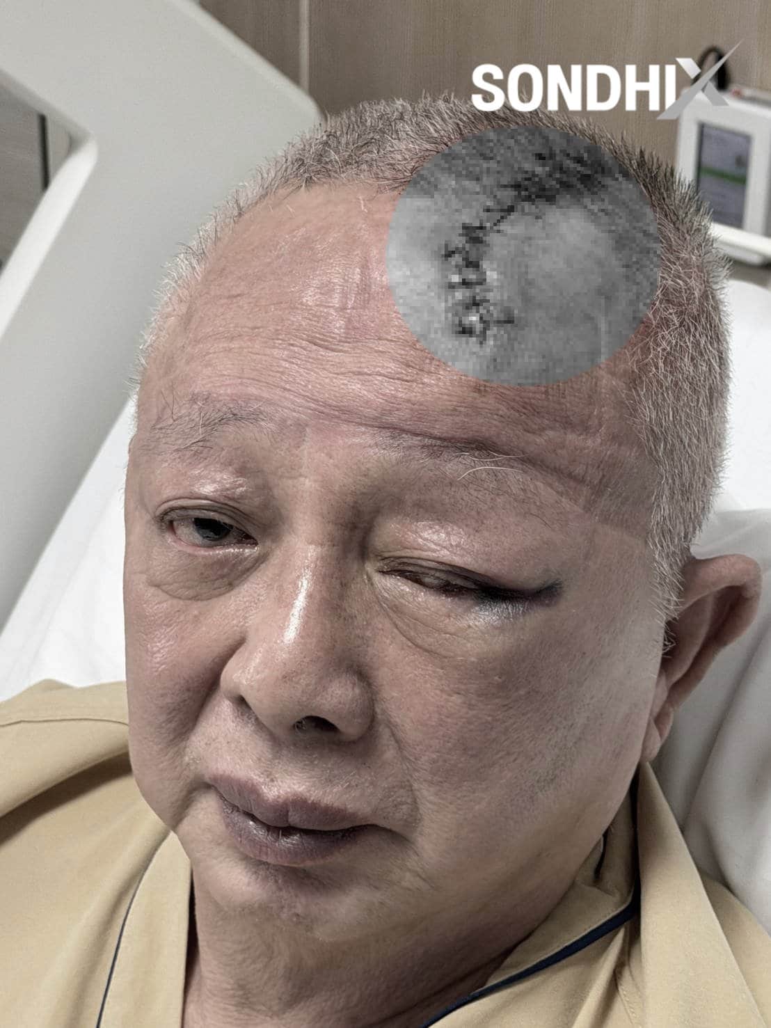 สนธิ ลิ้มทองกุล ล้มหัวฟาดเสา เย็บ 20 เข็ม ประกาศงดจัดรายการนาน 3 สัปดาห์ แฟนข่าวแห่เป็นห่วง-4